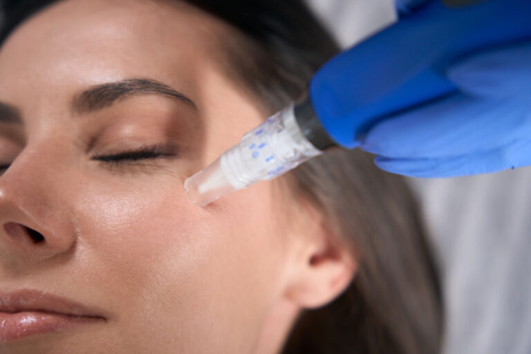 Close-up of a microneedling device on the skin, supporting content on how often you should get microneedling.