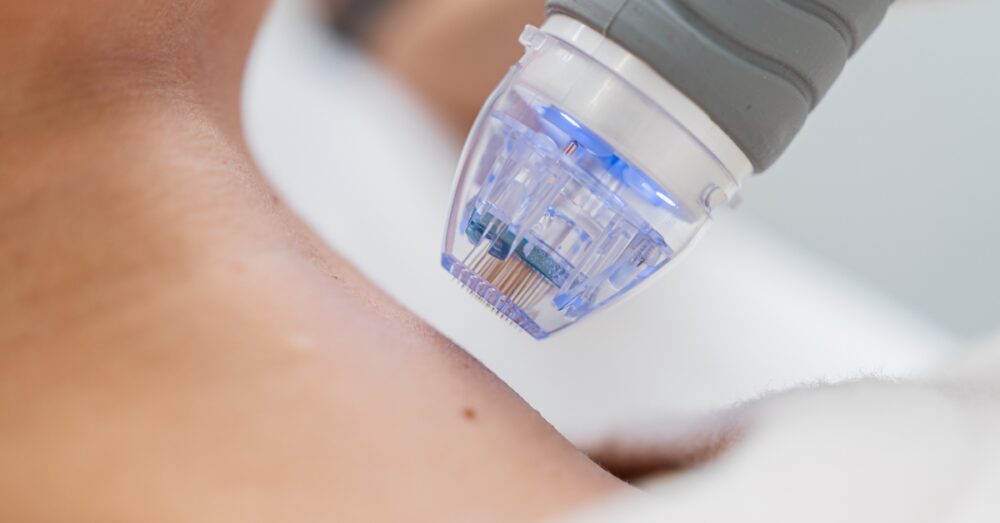 Close-up of a microneedling device