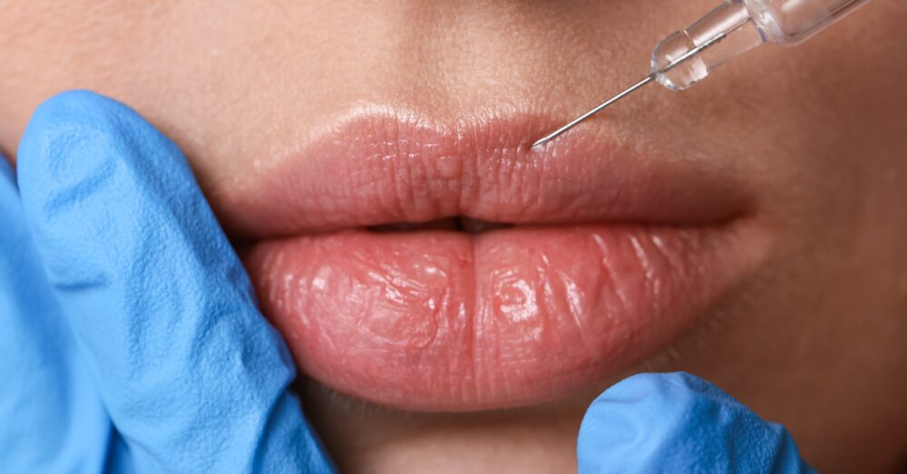 Close-up of a woman's lips receiving a dermal filler injection from a provider wearing blue medical gloves, with a fine needle positioned near the lower lip