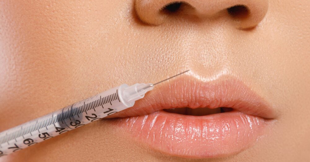 Close-up of a lip filler injection being performed near the vermillion border of the lips